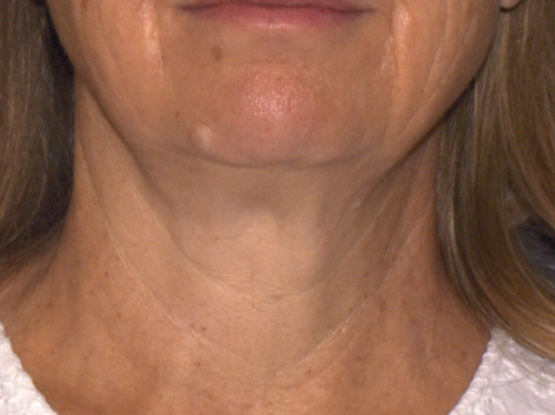 Neck after Sofwave treatment