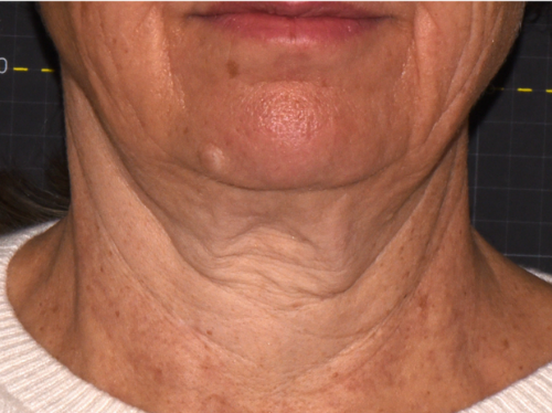 Neck before Sofwave treatment