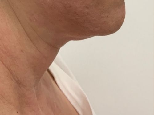 Submental before Sofwave treatment skin tightening done