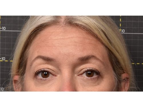 Brows before Sofwave treatment