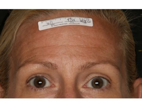 Eyebrows after Sofwave treatment