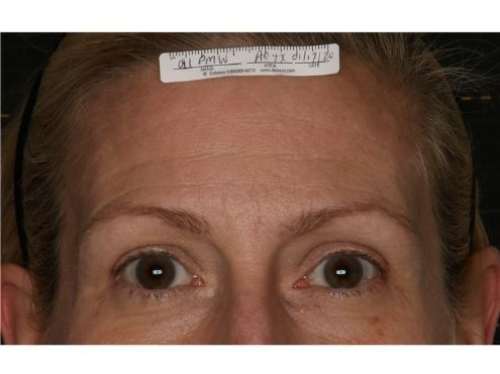 Eyebrows before Sofwave treatment