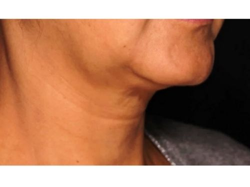 Submental before Sofwave treatment skin tightening