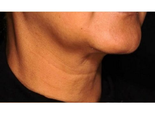 Submental after Sofwave treatment skin tightening