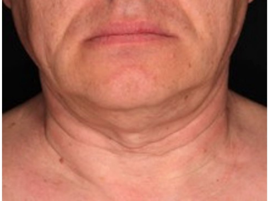 Neck before Sofwave treatment done