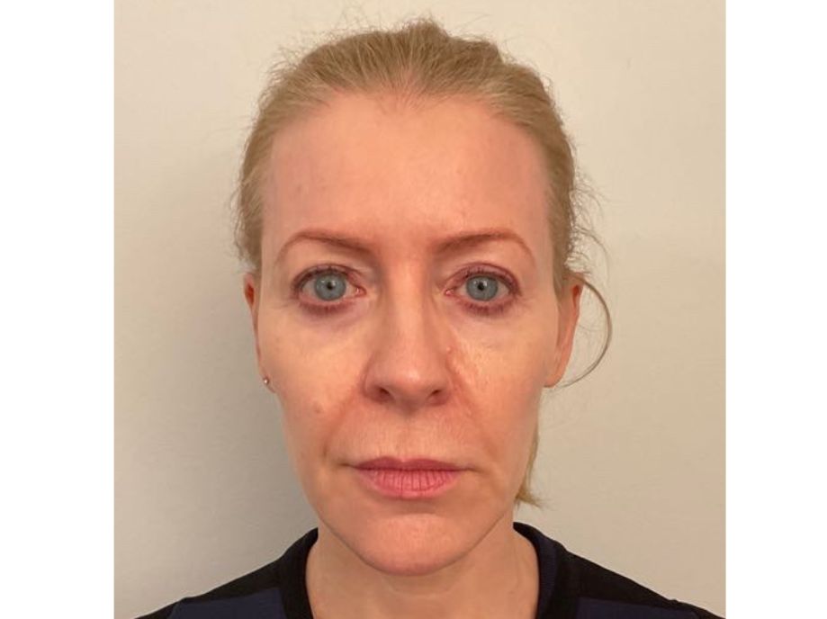 after sofwave treatment on face with Verity Nolan NP